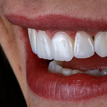 Image that shows a person smiling a showing her new dental veneers