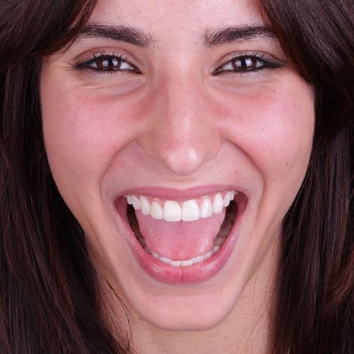 Woman smiling and showing her cosmetic composite bonding treatment